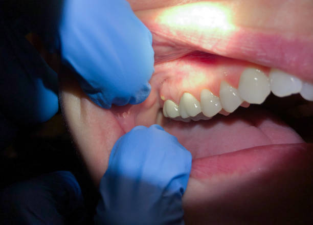 Best Emergency Root Canal Treatment in Crawfordville, FL
