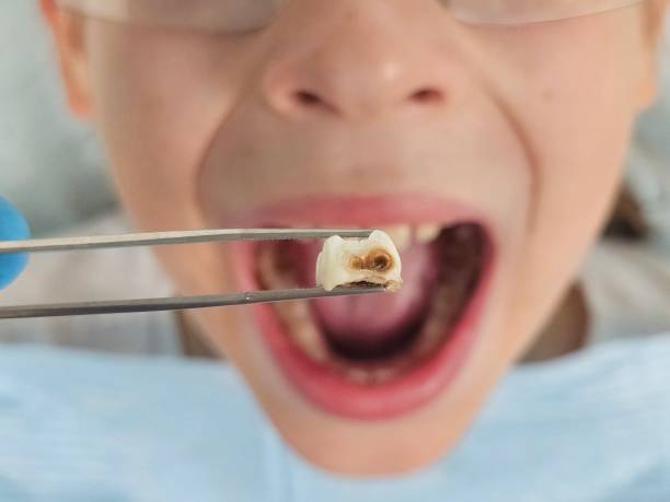 Best Emergency Dentist for Lost Fillings or Crowns in Crawfordville, FL